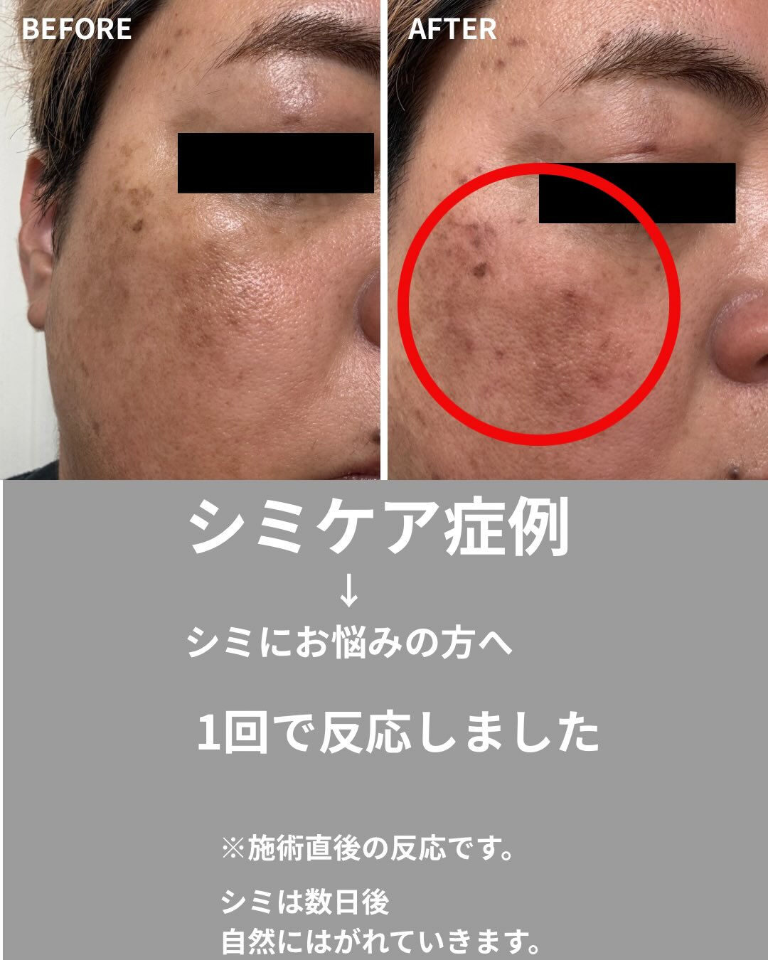 【シミケア症例】