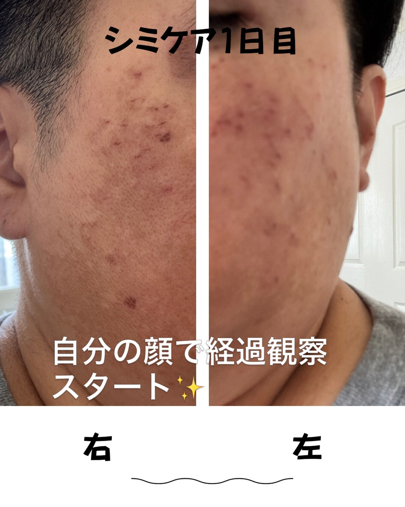 昨日は自分の顔をシミケアしました😊