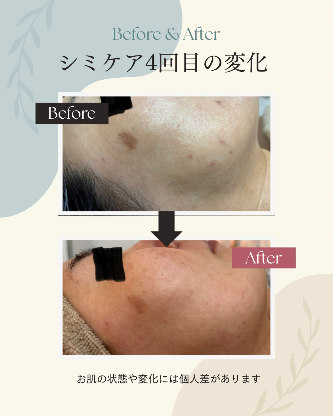 シミケア 4回目のBefore → After